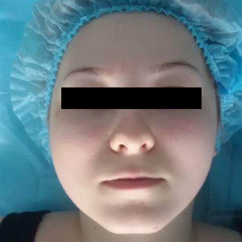 Удаление бородавки с лица - новейшая лицевая хирургия в городе Видное